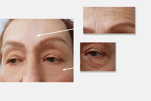 face woman wrinkles face before and after procedures