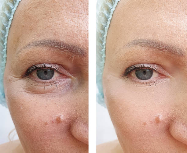 woman face wrinkles before and after treatments