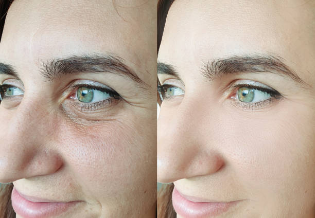 woman face wrinkles before and after treatment collage