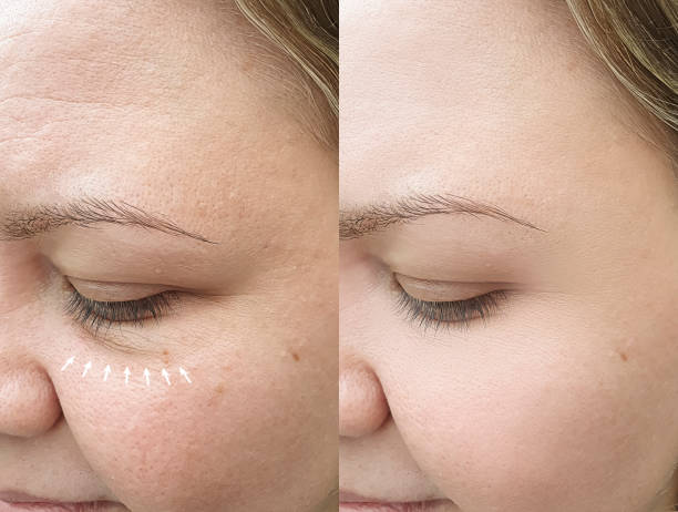 Caucasian girl face wrinkles after removal