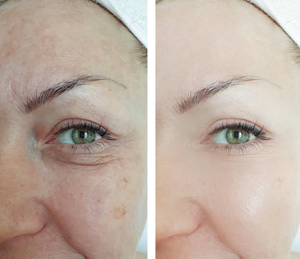 woman eyes wrinkles before and after treatment