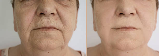 woman face wrinkles before and after treatment