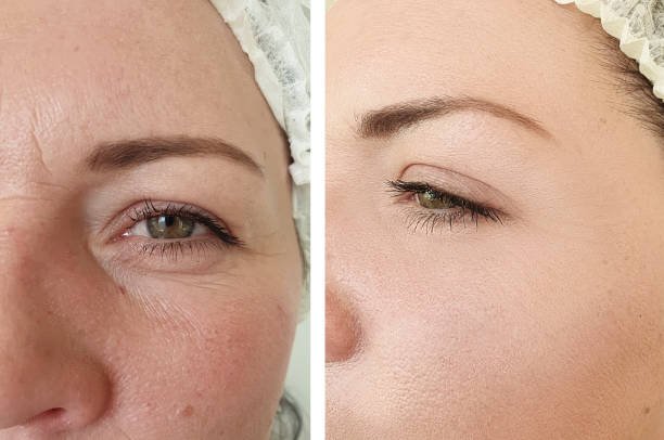 woman face wrinkles before and after treatment