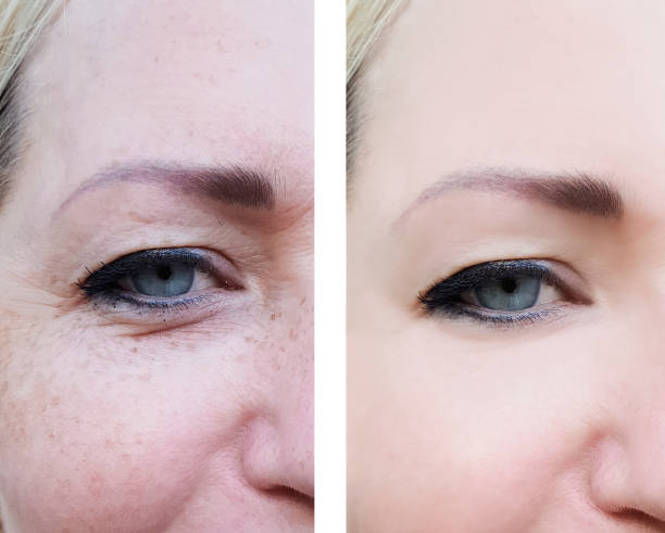 face woman wrinkles before and after pigmentation