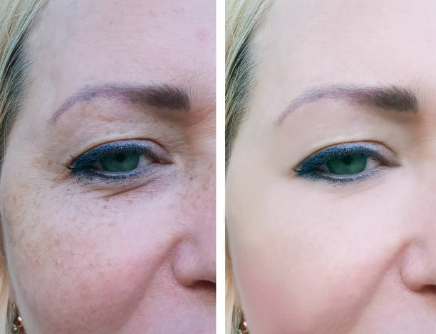 face woman wrinkles before and after pigmentation