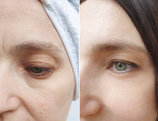woman face wrinkles before and after treatment