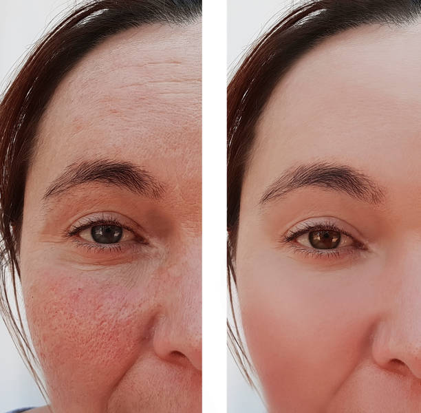 wrinkles of an eye woman's face before and after cosmetic procedures