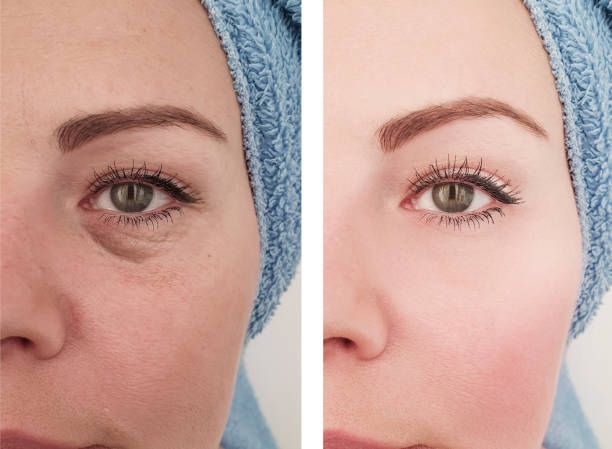 female eyes wrinkles before and after treatments