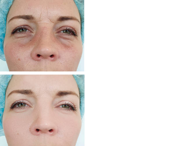 female eyes bloating before and after treatment