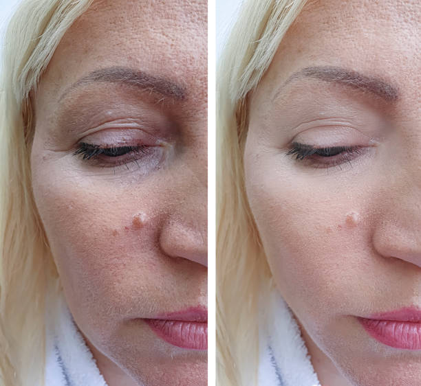 woman face wrinkles before and after treatment