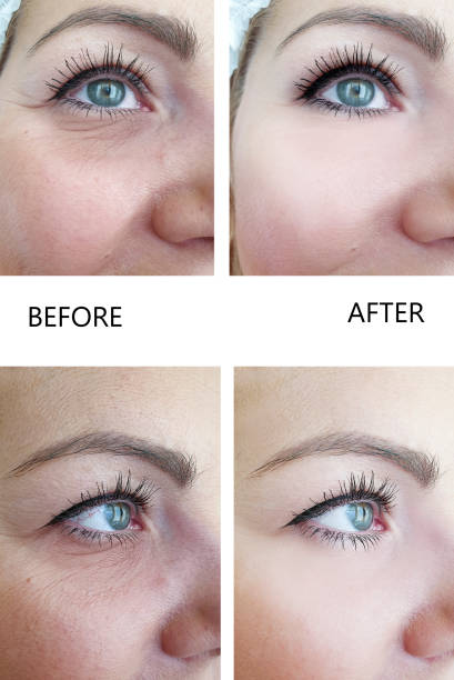 woman wrinkles before and after the procedure