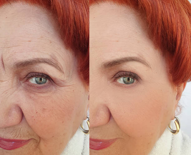 face old woman wrinkles before and after treatment