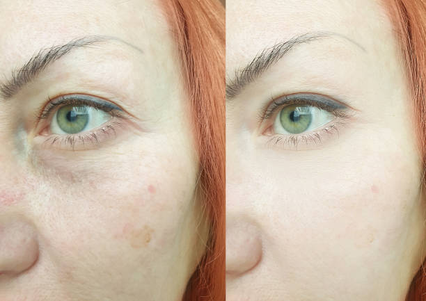 woman face wrinkles before and after treatment