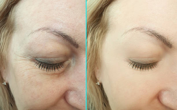 woman face wrinkles before and after collage treatment
