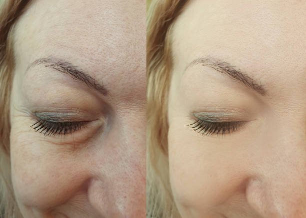 woman face wrinkles before and after collage treatment