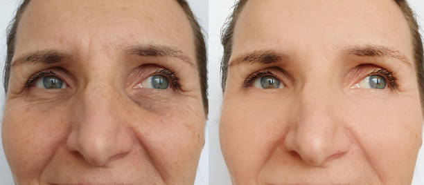 woman face wrinkles before and after treatment