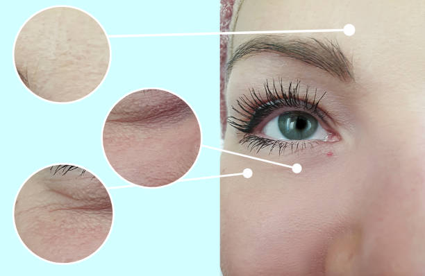 woman face wrinkles before and after collage treatment