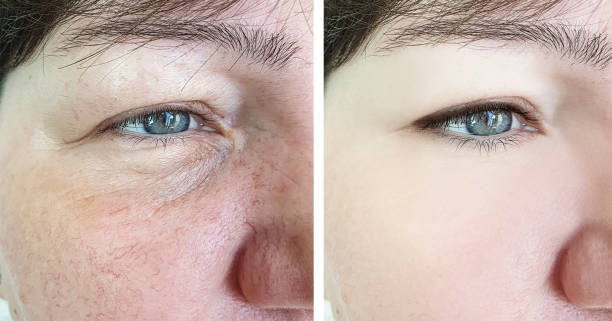 face of an elderly woman wrinkles before and after procedures
