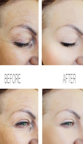 woman wrinkles face before and after procedures