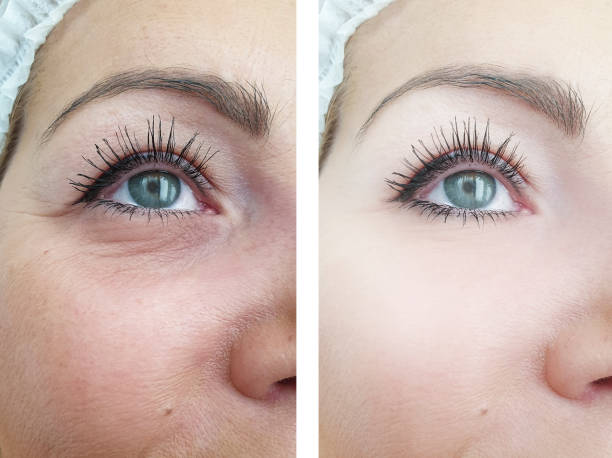 woman wrinkles face before and after procedures