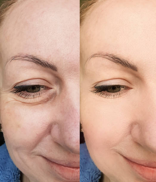 woman face wrinkles before and after treatment