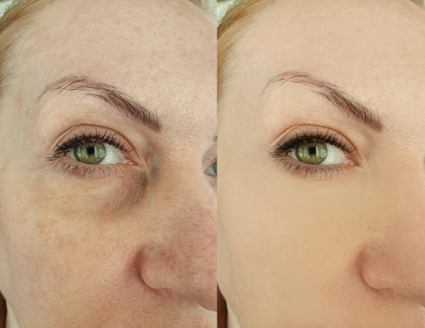 woman eye wrinkles before and after treatment, blephroplasty