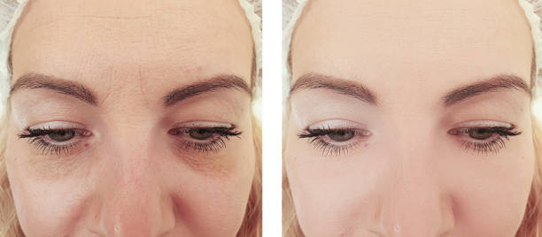 woman wrinkles before and after procedures