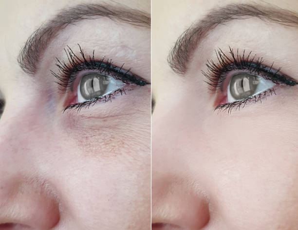 woman wrinkles face before and after treatment