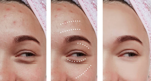 female eyes wrinkles before and after treatments