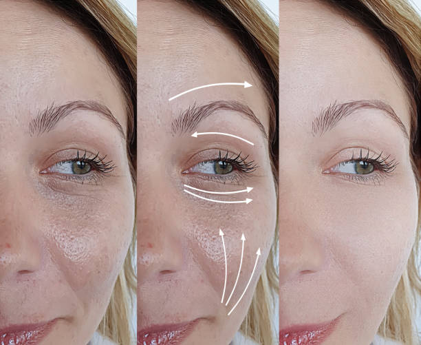 woman face wrinkles before and after treatment