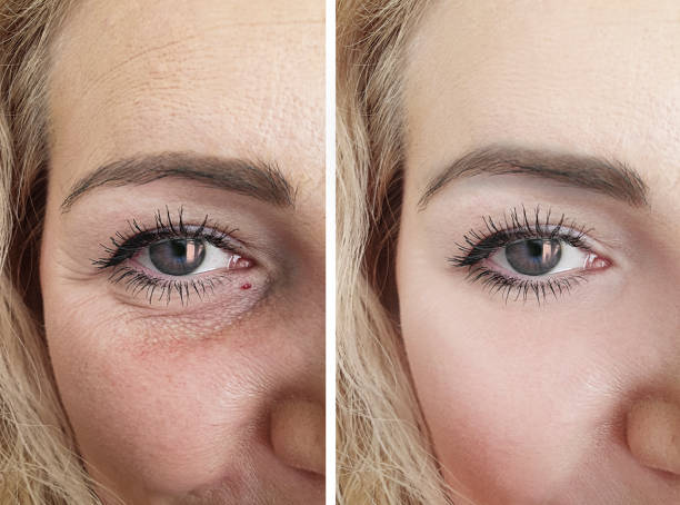 female eyes wrinkles before and after correction procedures