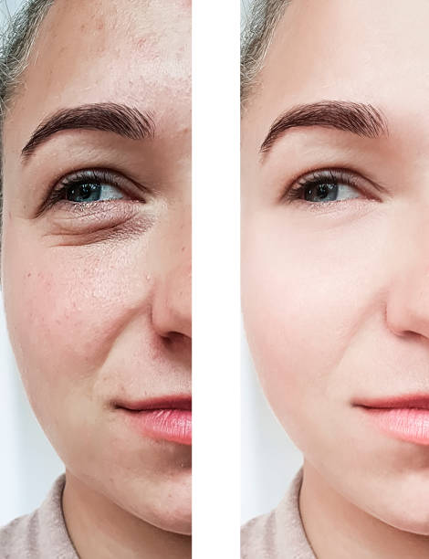 girl wrinkles eyes before and after procedures
