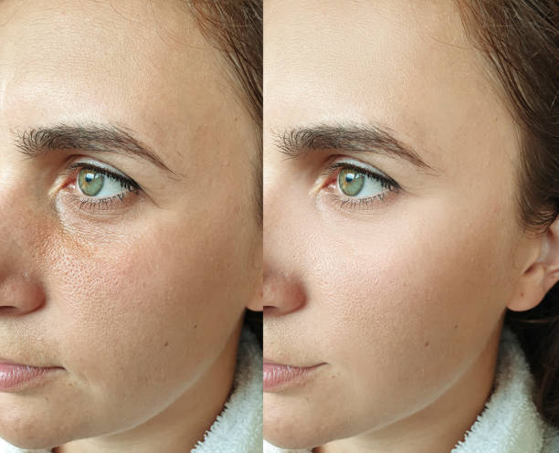 woman face wrinkles before and after treatment collage