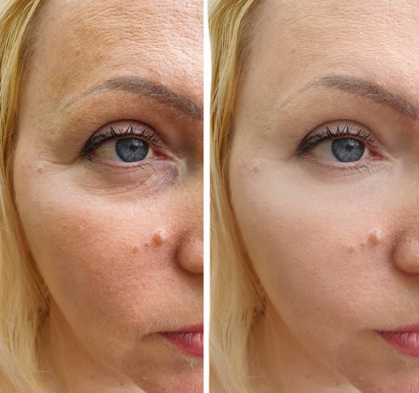 woman face wrinkles before and after treatment