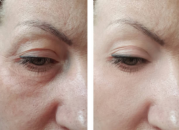 woman eyes wrinkles before and after treatment