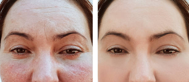 woman wrinkles face before and after treatments