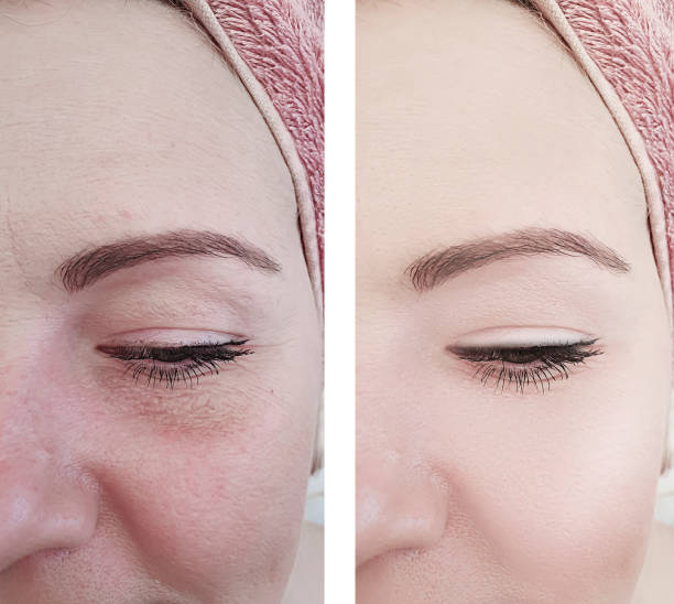 woman wrinkles before and after treatment