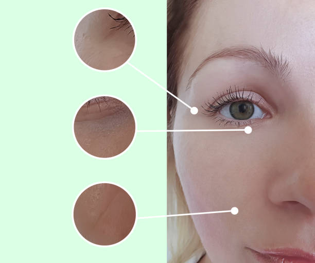 woman face wrinkles before and after treatment