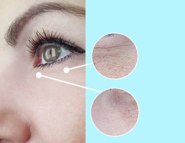 woman face wrinkles before and after treatment collage