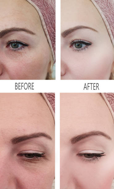 woman wrinkles before and after procedures