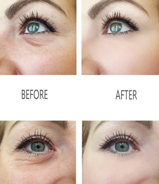 woman wrinkles before and after procedures