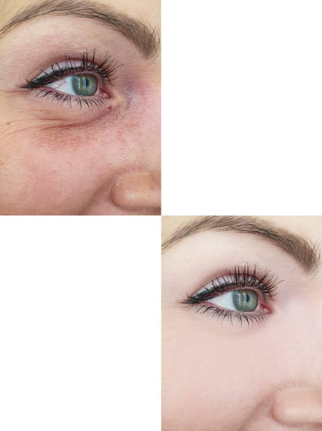 woman face wrinkles before and after treatment