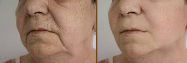 woman face wrinkles before and after treatment