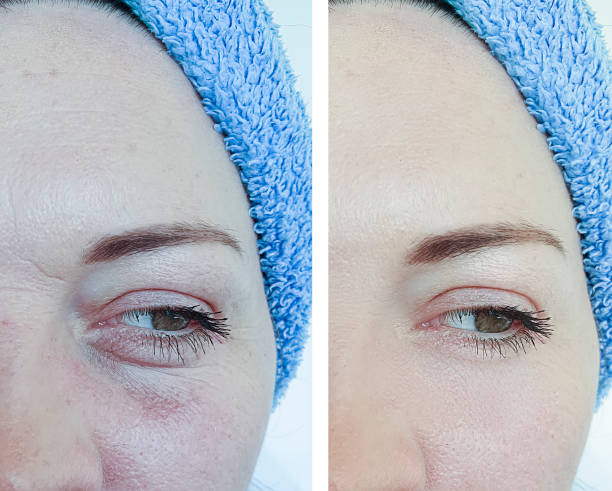 woman face wrinkles before and after treatment collage