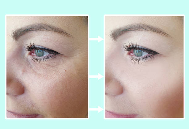 woman wrinkles before and after procedures