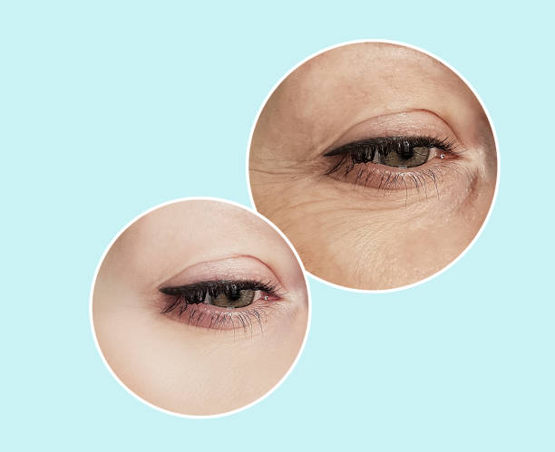 woman eye wrinkles before and after procedures retouching