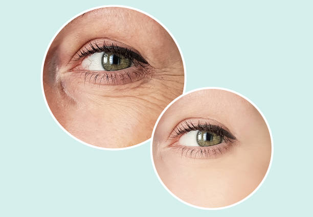 woman eye wrinkles before and after procedures retouching