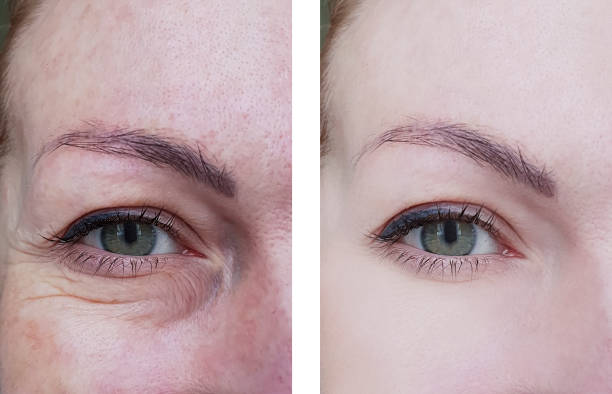 woman wrinkles before and after treatments