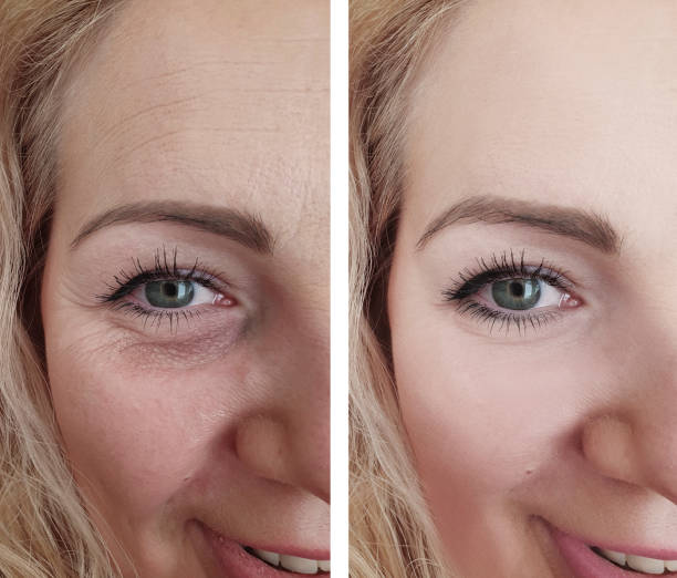 woman face wrinkles before and after treatment
