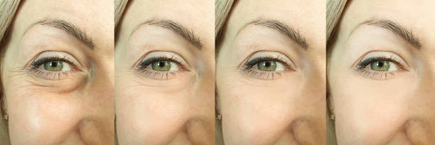 woman face wrinkles before and after treatment, collage,